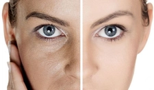 Açık Gözenekler Nasıl Kapanır? Açık Gözenekler Nasıl Kapanır?