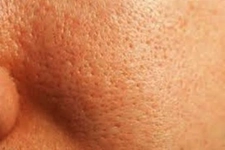 Aloe Vera Gözenek Sıkılaştırıcı Kullanımı ve Etkileri Aloe Vera Gözenek Sıkılaştırıcı Kullanımı ve Etkileri