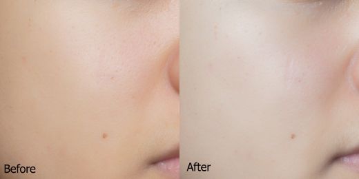 Gözenek Küçültücü